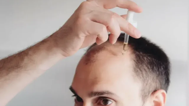 Best Hair Loss Treatments in 2025: What Really Works?